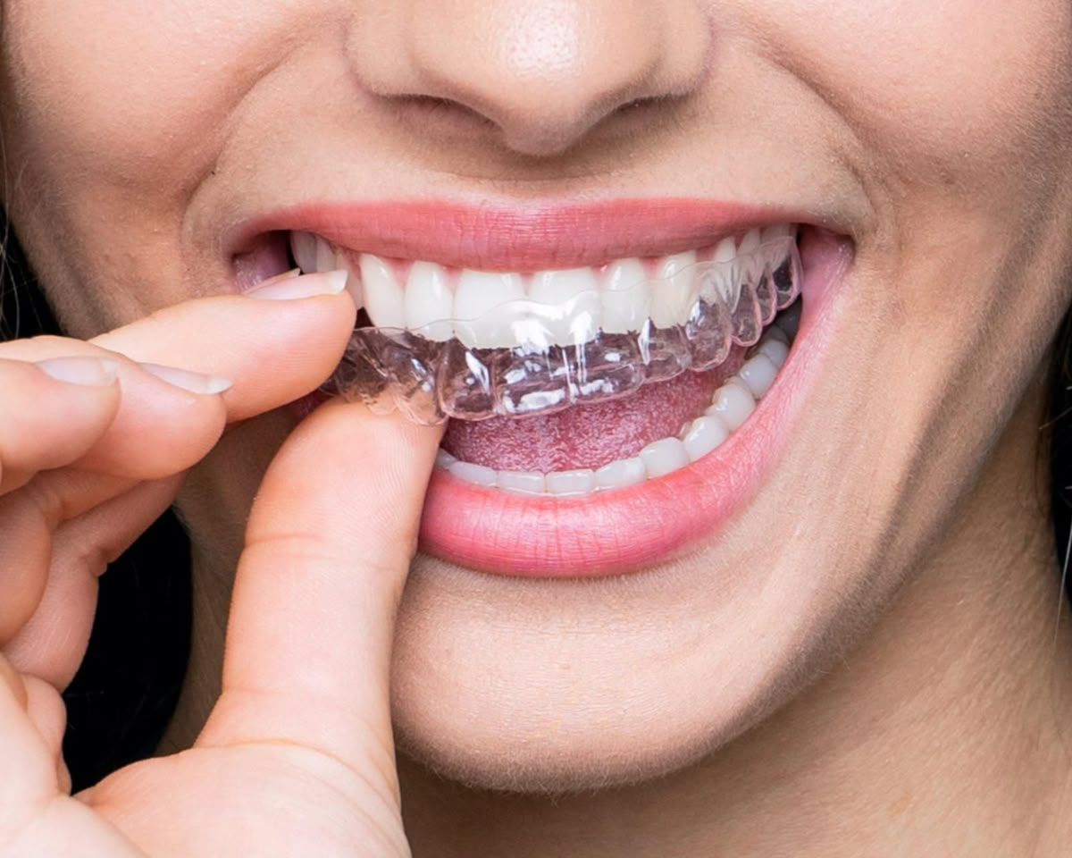 Gap-Free Smile Is Your Dream? How Aligners May Help You?