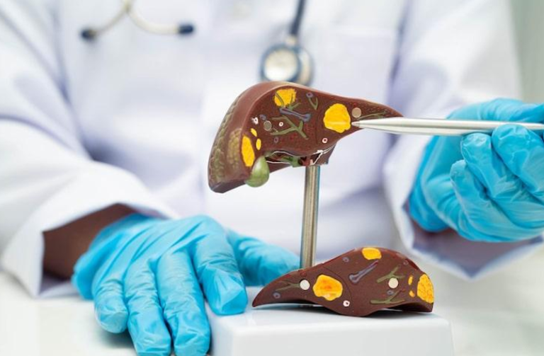 7 Factors to Consider When Seeking Homeopathic Support for Fatty Liver